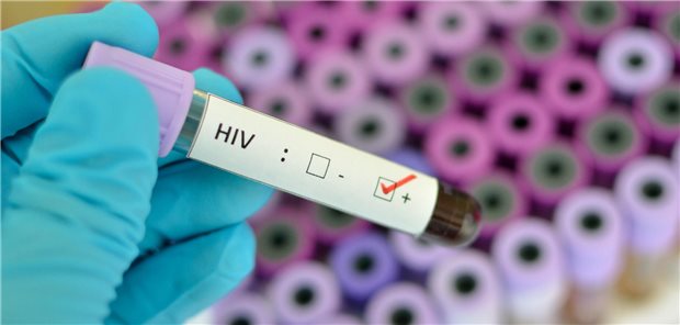 HIV positiv: Die Diagnose wurde 2021 vergleichsweise oft in Berlin, Frankfurt am Main und Köln gestellt.