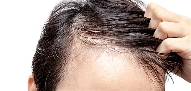 Haarausfall! Als Arzneien kommen primär Minoxidil und Finasterid infrage.