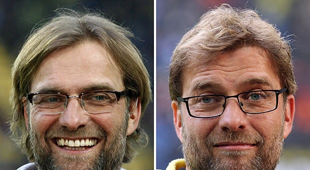 Potenzsymbol und Naturpullover Haarvergleich: BVB-Trainer Jürgen Klopp vor und nach der Haartransplantation.