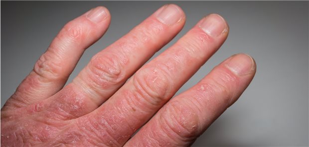 Häufig entwickelt sich zuerst eine Psoriasis, oft erst Jahre später dann eine Psoriasis-Arthritis.