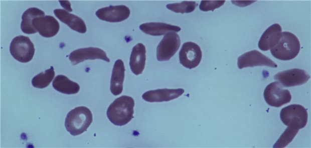 Häufiger auch hierzulande: Sichelzellanämie.