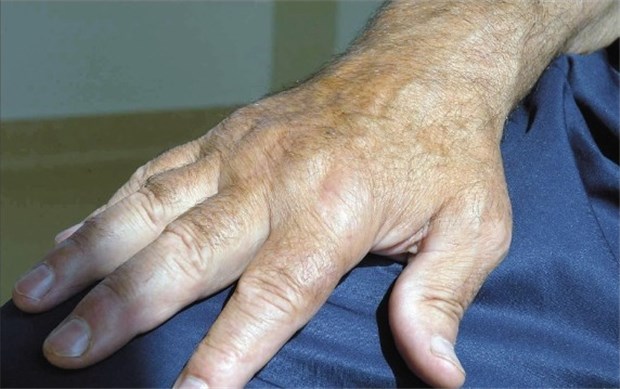 Coxibe spielen ihre Trümpfe besonders im Dünndarm aus Hand eines Patienten mit Gelenkschwellungen. In der Therapie bei entzündlich-rheumatischen Erkrankungen sind NSAR unverzichtbar.