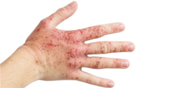 Hand eines Patienten mit Neurodermitis.