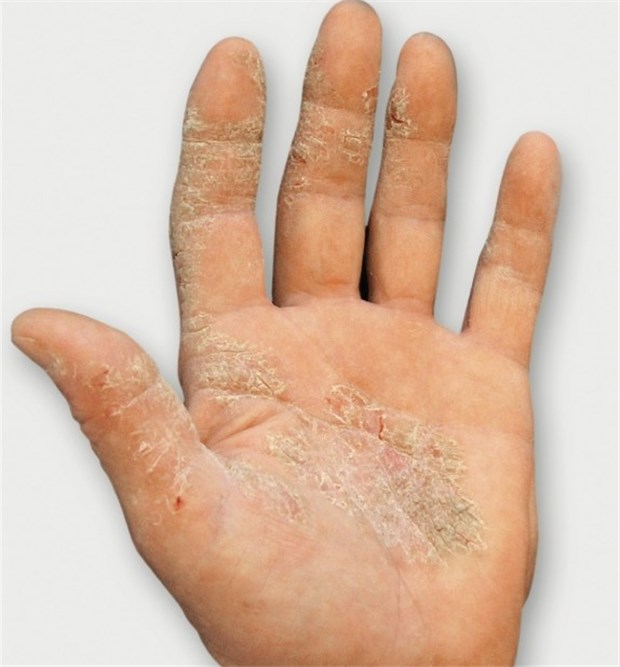 Dermatologen legen neue Leitlinie fürs Handekzem vor Hand eines Patienten mit schwerem chronischem Ekzem vor der Therapie mit 30 mg Alitretinoin einmal täglich.