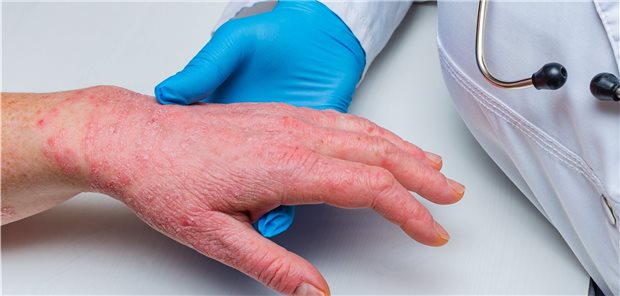 Handekzem: Jetzt Expositionen in Beruf und Freizeit abzufragen, ist ebenso wichtig wie Verlauf, Verteilung und Erscheinungsbild.