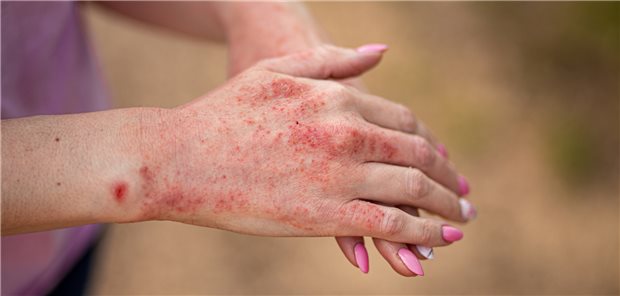 Handekzem: Vor allem viele Menschen in medizinischen Berufen sind betroffen.