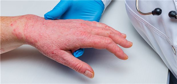 Handekzeme haben seit Corona zugenommen. Das sagen rund 84 Prozent der Dermatologen in einer Umfrage des BVDD.