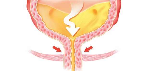 Harninkontinenz – ein lästiges Problem.