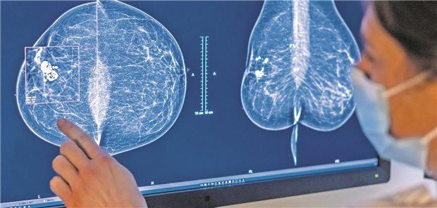 Hat die Mammographie bald ausgedient? Aus den bisherigen Daten der ToSyMa-Studie geht hervor, dass die Tomosynthese der Standard-Screeningmethode überlegen ist.