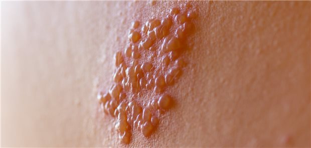 Herpes-Zoster-Bläschen