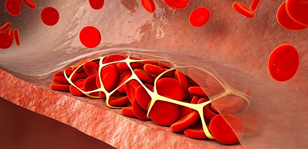 Einen Monat später ist jeder Zehnte tot Hauptrisikofaktoren für venöse Thromboembolien: Krebs, Klinikaufenthalte und Operationen.