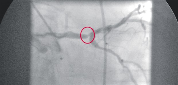 Was ist besser - PCI oder Bypass? Hauptstammstenose in der Koronarangiografie.
