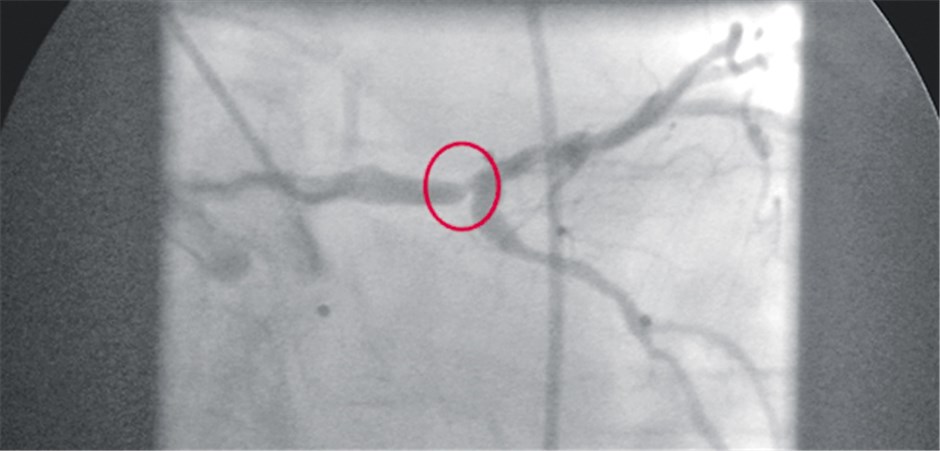 Was Ist Besser PCI Oder Bypass Was Ist Besser PCI Oder Bypass