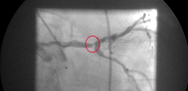 Hauptstammstenose in der Koronarangiografie. Koronarläsionen bei Diabetikern zeigen häufig ein diffuses Verteilungsmuster.