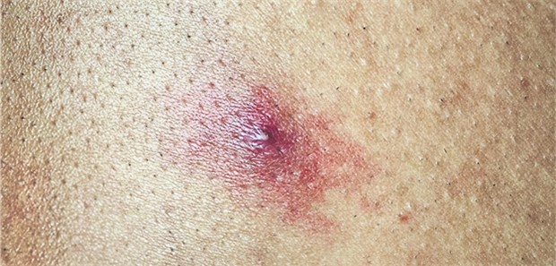 Bei Hautabszessen immer auch ein Antibiotikum? Hautabszesse werden häufig durch S. aureus verursacht.