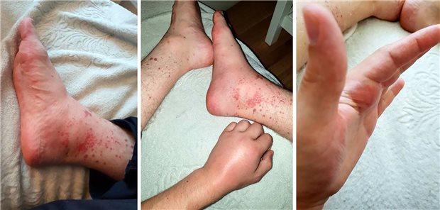 Hautausschlag und schmerzhafte Schwellung des rechten Knöchels (links); makulopapulöser Hautausschlag an allen Extremitäten (mitte); subkutaner Knoten auf der Handinnenfläche (rechts).