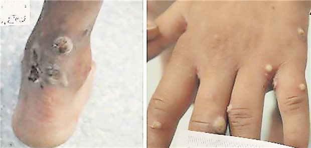 Hautbefunde bei Krankenhausaufnahme: Rundliche, tiefe Ulzerationen mit gold-gelblichen Belägen an den Fersen (links) und vorwiegend pustulöse Läsionen an den Händen (rechts).
