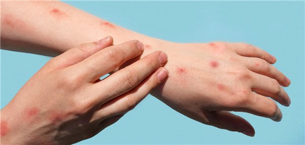 Hauteffloreszenzen infolge einer Infektion mit Affenpocken. Diese werden offenbar sowohl über die Läsionen als auch über Speichel und Sperma übertragen, berichten spanische Forscher.
