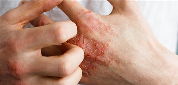 Hautekzem: Häufiges Händewaschen gehört zu den vermeidbaren Risikofaktoren.