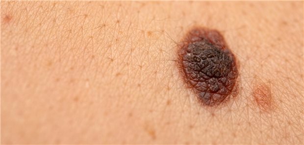Hautkrebs: Im Frühstadium sind Melanome nur schwer von anderen Hauttumoren zu unterscheiden. KI kann die Diagnostik unterstützen. Doch viele Dermatologen misstrauen den für sie nicht nachvollziehbaren Entscheidungen der Algorithmen.