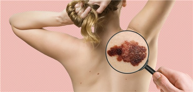 Hautkrebs wird häufiger, aber die Vorsorge schwächelt Hautkrebs. Zu spät erkrannt, verläuft er auch heute noch häufig tödlich. Experten raten daher zum regelmäßigen Screening.