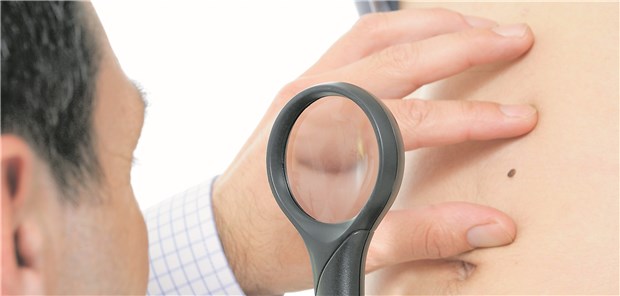 Hautkrebsscreening: Bei Verheirateten werden mehr Melanome im Stadium T1a diagnostiziert.