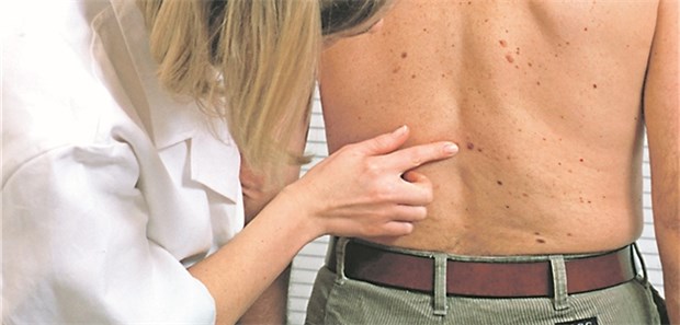 Hautkrebsscreening: Falls dabei Krebsvorstufen entdeckt werden, ist die Frage wichtig, ob diese berufsbedingt entstanden sein könnten.