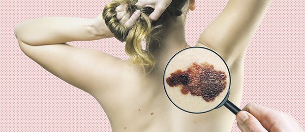 Hautkrebsvorsorge: Die Therapiechancen für Betroffene haben sich verbessert.