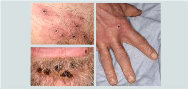 Hautläsionen bei Patienten mit Affenpocken-Infektion.