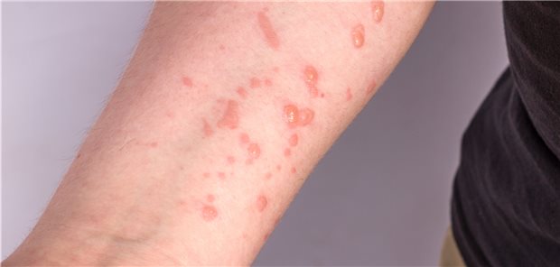 Die durch eine Infektion mit MPV hervorgerufenen Hautveränderungen in verschiedenen Stadien.