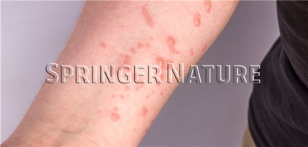 Erscheinungsbild von Affenpocken: Symptome und Aussehen erklärt Erscheinungsbild von Affenpocken: Symptome und Aussehen erklärt