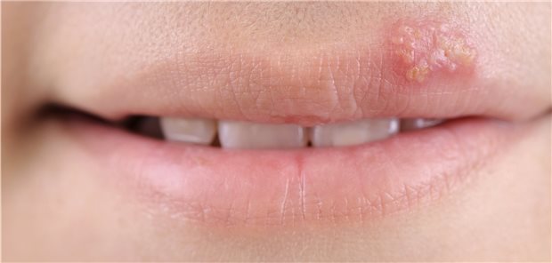 Neue Wirkstoff-Kombi könnte Herpes-Therapie verbessern Herpes labialis: Die Kombi von PPI plus Aciclovir könnte hier eine künftige Therapieoption sein.