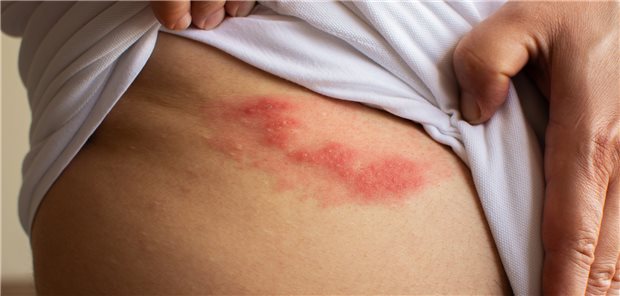 Herpes zoster: Aller Wahrscheinlichkeit nach liegt es nicht an einer vorausgegangenen Impfung gegen SARS-CoV-2.