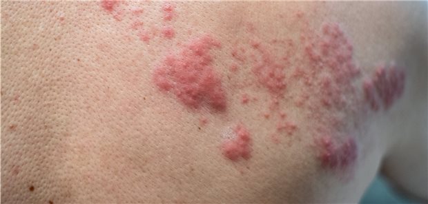 Herpes zoster: Das Robert Koch-Institut geht davon aus, dass jeder Zweite, der das 85. Lebensjahr erreicht, einmal im Leben erkrankt