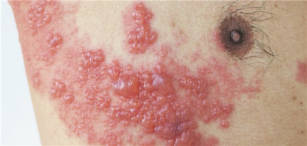 Herpes zoster: Die STIKO empfiehlt nun eine Impfung für alle ab 60 Jahren sowie für Menschen mit Grunderkrankungen ab 50.