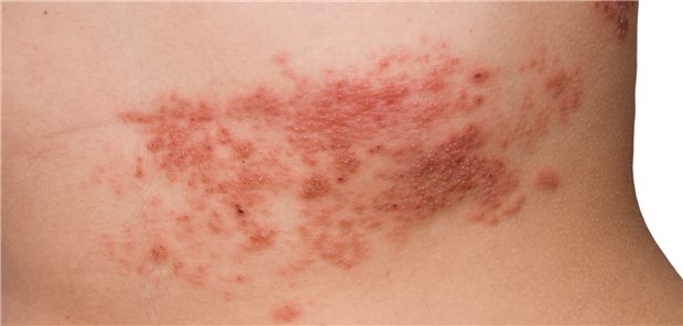 Auf viele Fragen gaben fünf Impf-Spezialisten Antworten Herpes zoster: Für eine anschließende Impfung gegen das Virus müssen die Symptome abgeklungen und der Patientbeschwerdefrei sein.