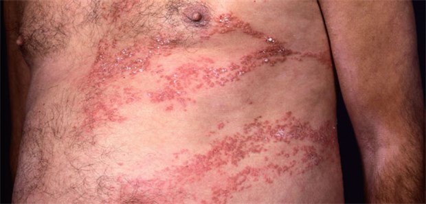 Hochwirksamer Impfstoff soll noch 2016 in die Zulassung Herpes zoster: Jeder fünfte über 50 Jahre erkrankt daran.