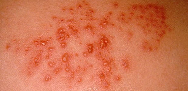 Herpes zoster am Oberschenkel.