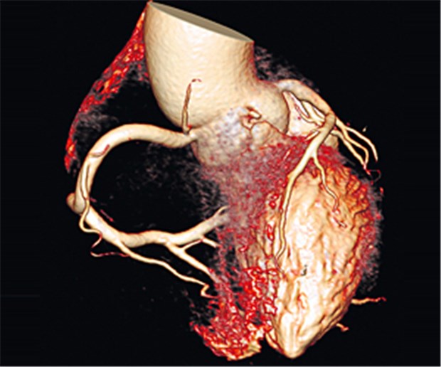 Bildgebung erschließt neue Horizonte Herz-CT mit Flash Spiral Cardio mit einer niedrigen Dosis von 0.97 mSv.