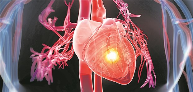 Herzinfarkt: Die Zahl der Patienten mit Komorbiditäten wie Diabetes, hatte mit der Zeit zugenommen, so ein Ergebnis der Analyse.