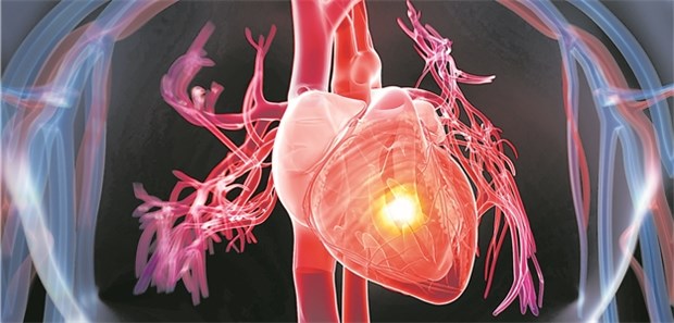 Welche STEMI-Patienten haben den besten Langzeitverlauf? Herzinfarkt: Ob STEMI-Patienten am Wochenende oder an einem Werktag im Krankenhaus aufgenommen wurden, hatte keinen Einfluss auf die Mortalität.