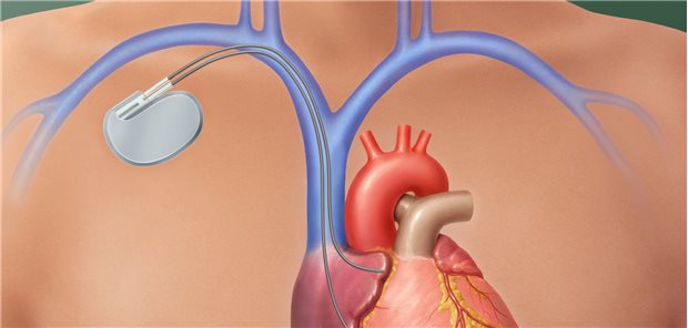 Herzschrittmacher an Ort und Stelle: Nach der Implantation eines kardialen elektronischen Devices sollten Patienten die Anzeichen einer Infektion kennen, sagen Forscher aus Kanada.
