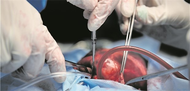 Nach Herztransplantation erkrankt jeder Zehnte an Krebs Herztransplantation: Besonders das Risiko für Hauttumoren steigt.