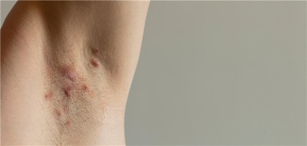 Entzündete Talgdrüsen in der Achsel eines Menschen.