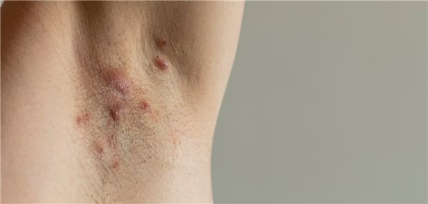 Kleine, entzündliche Knoten in der Axilla.