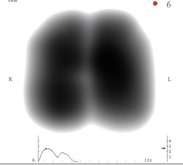 Lungen-Diagnostik mit Mikrofonen Hier ist eine gesunde Lunge in Inspiration zu sehen: Alle Lungenlappen sind mit Luft gefüllt.