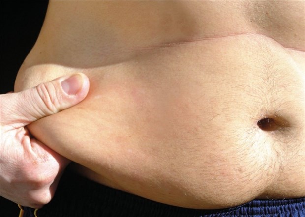 Pralle Fettzellen lassen neue Fettzellen sprießen Hier sitzen schädliche Fettzellen - Bauchfett ist besonders gefährlich für die Gesundheit.