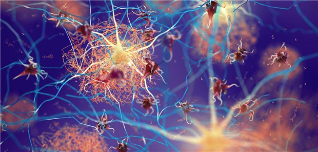 Hier stören Amyloid-ß-Proteine die Neuronenfunktionen und tragen so zur Entstehung einer Alzheimer-Demenz bei.
