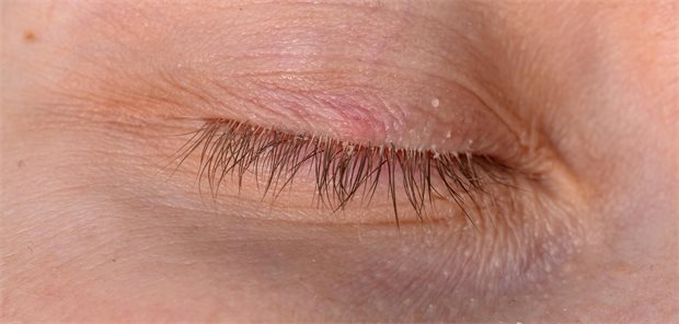 Demodex-Milbenbefall am Auge, verklebte Wimpern und eine rote Stelle auf dem Oberlid.