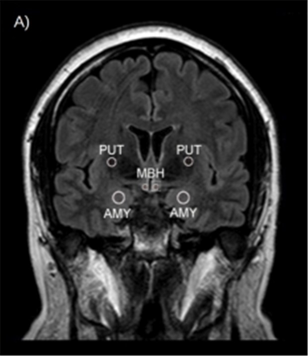 Wie Darmbakterien Übergewicht auslösen könnten Hirn im MRT: Im Zentrum ist der etwa drei Millimeter große Hypothalamus erkennbar (MBH).